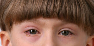 Блефарит у детей: симптомы и лечение