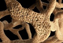 Что такое остеопороз: разговор простым языком