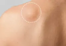 Что такое липома и нужно ли ее удалять