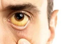 Как обнаружить синдром Жильбера на ранней стадии