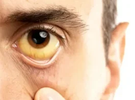 Как обнаружить синдром Жильбера на ранней стадии